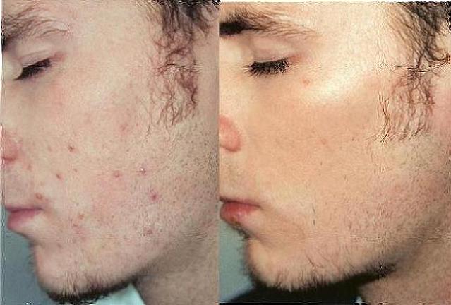 Adult Acne Grade III 